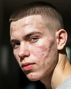 Sample portrait of a young man with acne to try in the AI face retouch tool